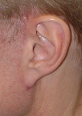 Revision Face Lift - Patient 5 - Lateral Left - Before Revision Face Lift - Patient 5 - Lateral Left - Before